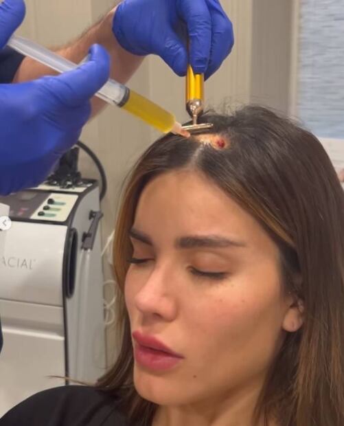 Génesis Aleska, exnovia de Nicky Jam, muestra impactantes fotos de su alopecia por ansiedad