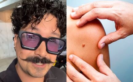 ¿Qué es el cáncer de piel, la enfermedad que padece Mau Nieto?; estos son sus síntomas