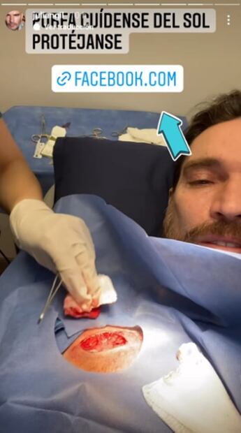 Julián Gil habla de la misteriosa cicatriz en el pecho: cáncer de piel