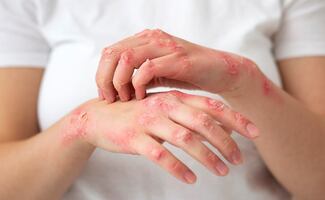 ⁠¿Qué es el herpes zóster; el virus de la varicela que puede reactivarse años después? 