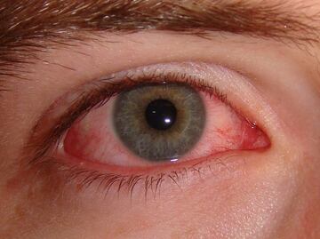 Conjuntivitis y herpes, enfermedades oculares más comunes en invierno