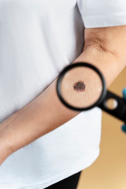 Ante su presencia, debe consultarse al dermatólogo para que la diagnostique correctamente. Fuente: Freepik.
