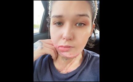 Entre dolor y revictimización: La historia de Liliana después de ser quemada viva en un intento de feminicidio en NL 