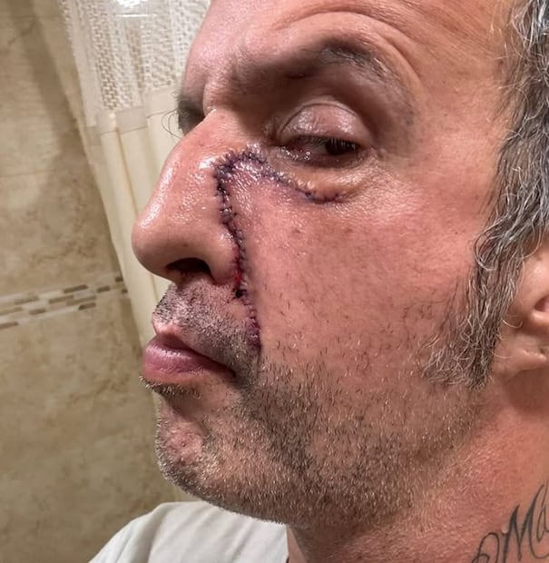 Tito Fuentes comparte cómo lucía  su rostro después de la primera cirugía a la que se sometió, después vinieron 11 intervenciones más.