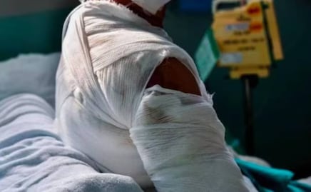 Sujeto rocía alcohol y le prende fuego a mujer en situación de calle en Venustiano Carranza