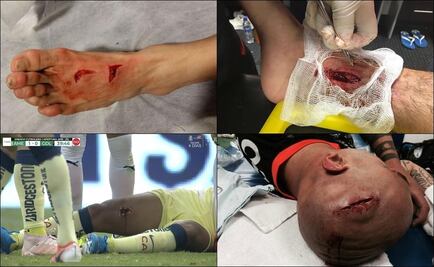 Las peores heridas por arteras entradas en el futbol