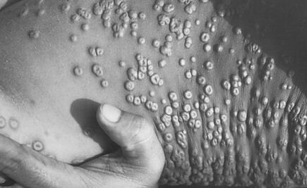 MC en el Senado llama al gobierno a garantizar prevención y atención por viruela símica