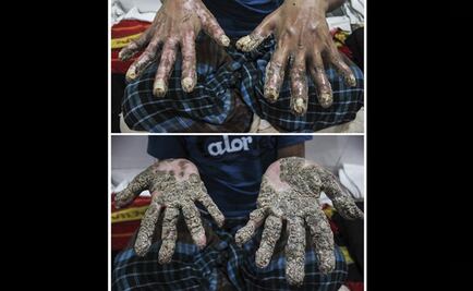 El "hombre árbol" ya fue operado