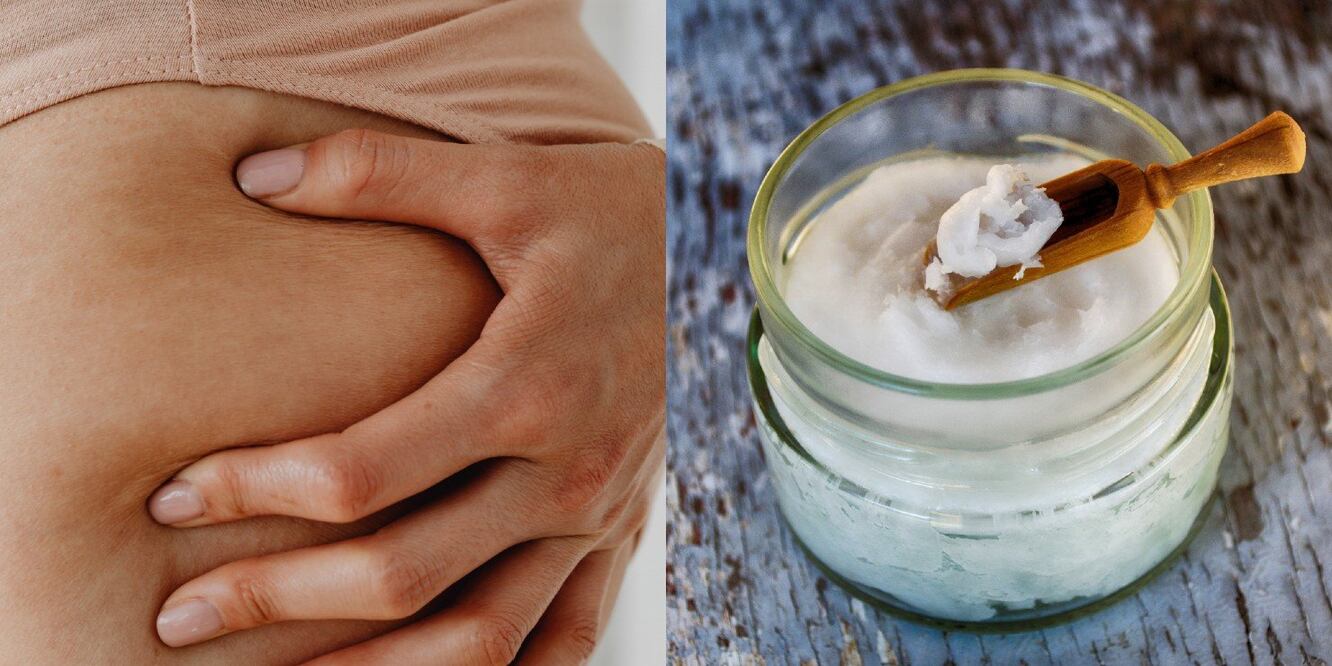 Ateuar las estrías en la piel es posible con ayuda del aceite de coco / Foto: Pexels