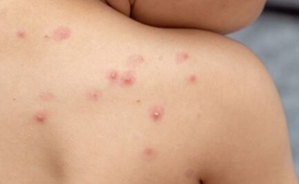 Detectan seis casos de viruela símica en Yucatán; activan vigilancia epidemiológica en Mérida