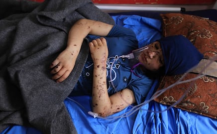 "¡Devuélvanme mis piernas!", el grito de niños amputados en la guerra Israel-Hamas en Gaza