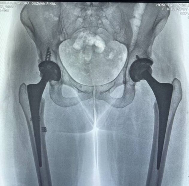 Alejandra Guzmán muestra radiografía y así se ve su cadera tras caída