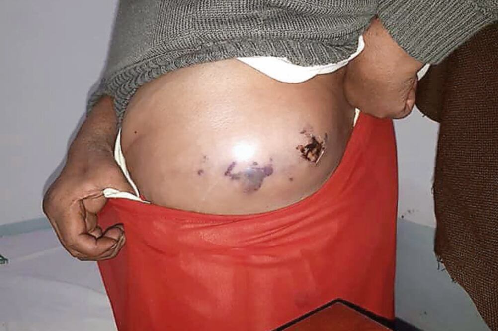 Las inyecciones, a base de dexametasona y presunta vitamina, provocaron abscesos y lesiones en el cuerpo de los pacientes (ESPECIAL)