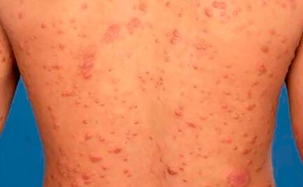 Día Mundial de la Lepra, enfermedad 100% curable y que sólo el 5% de la población es sensible a padecerla