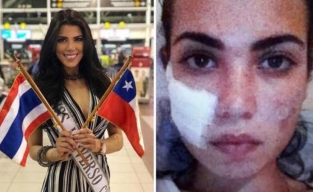 Concursante de Miss Universo muestra cómo superó daños en su cara por una cirugía estética