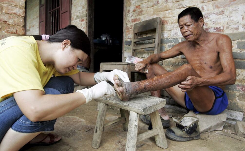 Imagen del 2007, en una población de Si Liangzhang, China. Aunque la lepra es una enfermedad muy antigua, sus características la convierten en uno de los patógenos más complicados de erradicar; Asia, África y América todavía tienen una considerable incidencia de casos, aunque los medicamentos y tratamientos disminuyeron su letalidad. Foto: Michael Reynolds/EFE.