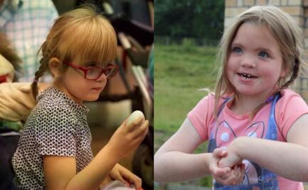 ¿Qué es el síndrome de Kleefstra? Conoce sus principales síntomas 