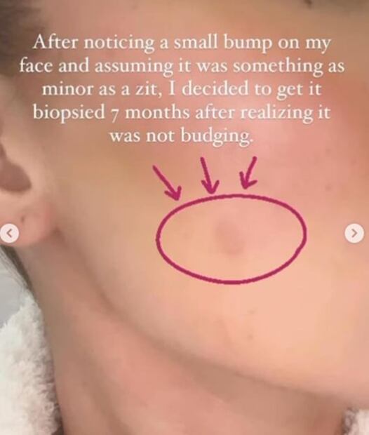 Khloé Kardashian, su diagnóstico de cáncer en la piel: todo lo que sabemos 