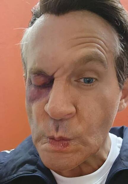 ¡Con el ojo morado! Arath de la Torre queda "igualito" que Alfredo Adame