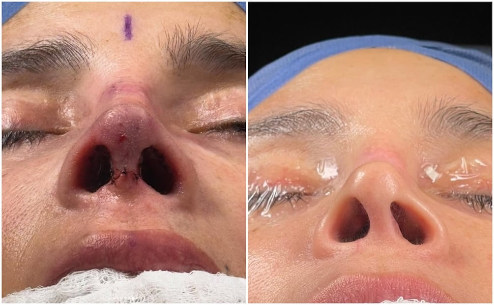 La actriz y modelo Dorismar se somete a una reconstrucción nasal, un procedimiento quirúrgico especializado que restaura la forma, estructura y función de la nariz.