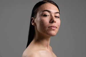 Qué no debes ponerte en la cara si tienes acné