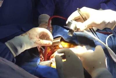 IMSS coloca con éxito un corazón artificial, el tercero en su historia 