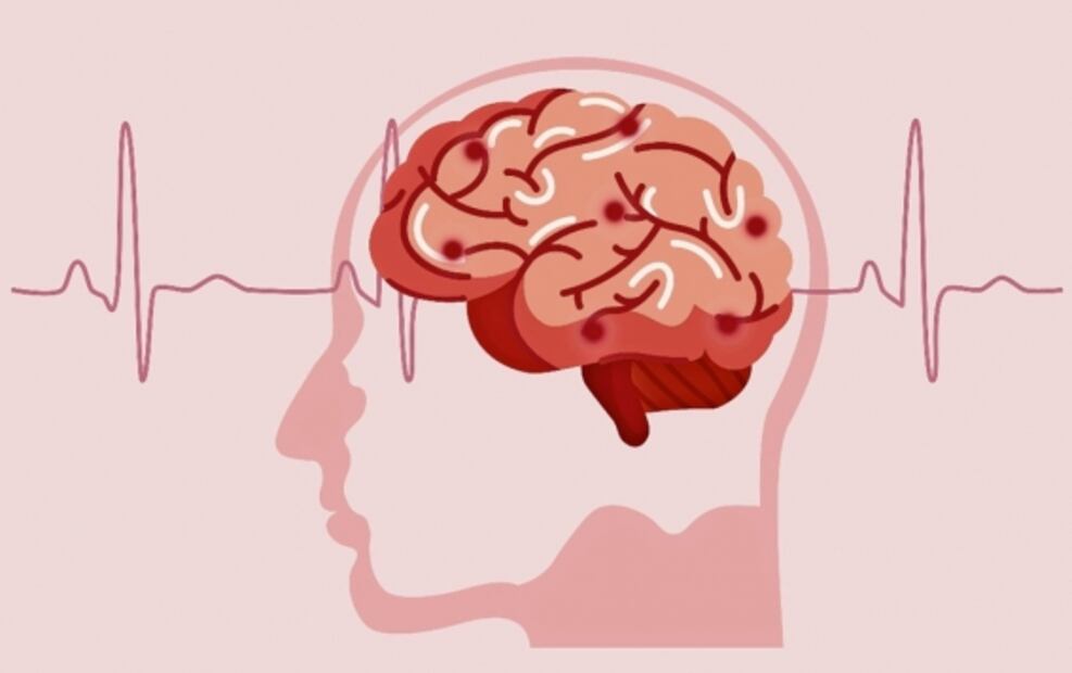 La covid-19 altera el volumen de materia gris en el cerebro