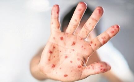 OPS advierte de brote de sarampión en México; alista estrategia con Secretaría de Salud para prevenir propagación del virus