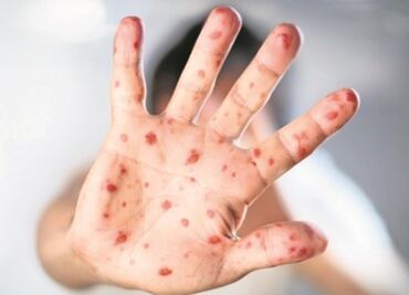 OPS advierte de brote de sarampión en México; alista estrategia con Secretaría de Salud para prevenir propagación del virus