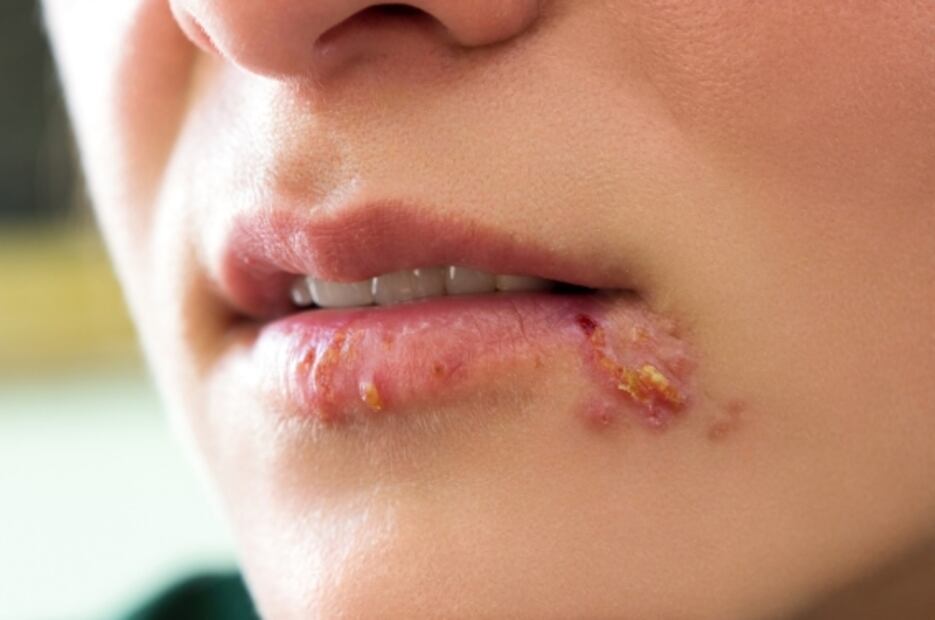 ¿Cuáles son los virus que permanecen escondidos en el cuerpo y rebrotan décadas después?