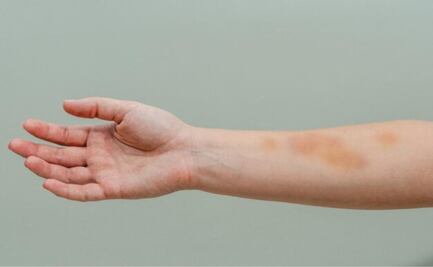 Esta es la vitamina que le falta a tu cuerpo cuando salen hematomas en tu piel