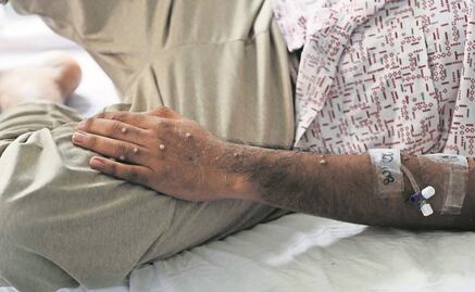 Brote de viruela del mono se debe a negligencia e incapacidad, dicen científicos africanos