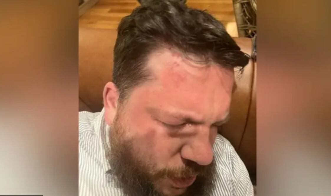 Leonid Volkov fue golpeado con un martillo afuera de su casa en Vilna, Lituania. Foto: BBC