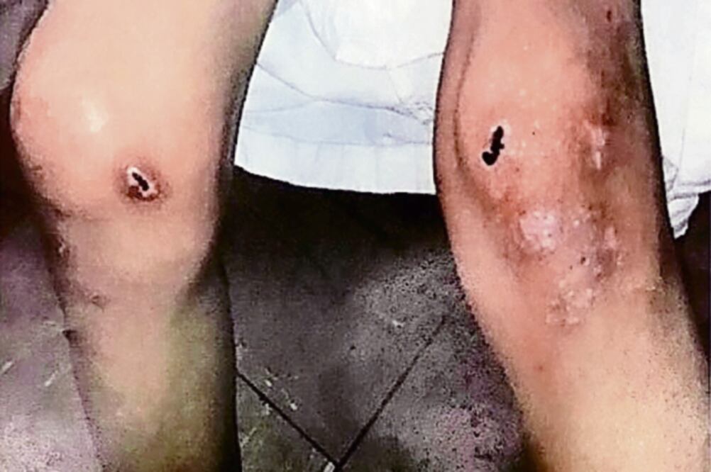 La niña era encadenada, golpeada y alimentada sólo con chiles encurtidos por su abuela, lo que le causó deformidades en el cuerpo (ARCHIVO EL UNIVERSAL)