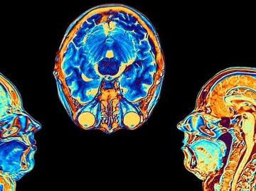 Día Mundial del Cerebro 2022: Los daños que provoca el Covid-19