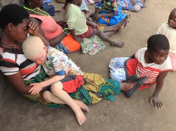 Se recrudece asesinato de albinos en Malaui