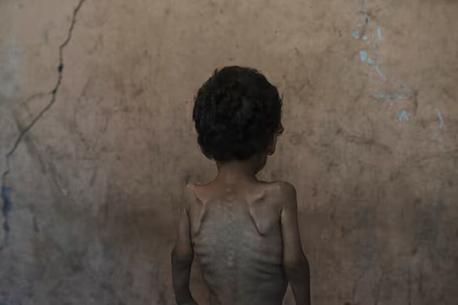 Yazan Abu Ful, un niño desnutrido de dos años, en el campo de refugiados Shati, en Ciudad de Gaza. FOTO: AP