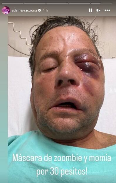 Alfredo Adame aún no puede salir del hospital; bromea con el aspecto de su rostro