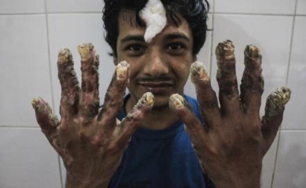 El "hombre árbol" ya fue operado