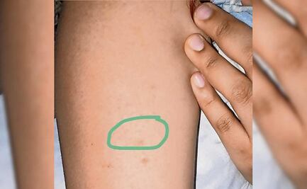 Acusa pinchazo en el Metro y que no siguieron protocolo 