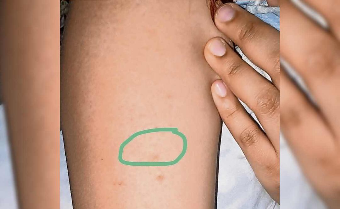 Michelle contó que tras el pinchazo se le adormecieron los brazos y ya no pudo andar, perdió movilidad y tuvo que sentarse en el suelo. Foto: Especial