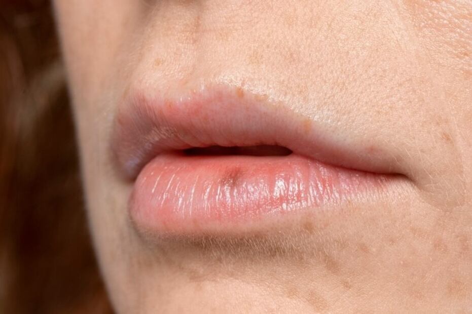 Remedios contra el herpes labial. Fuente: Freepik