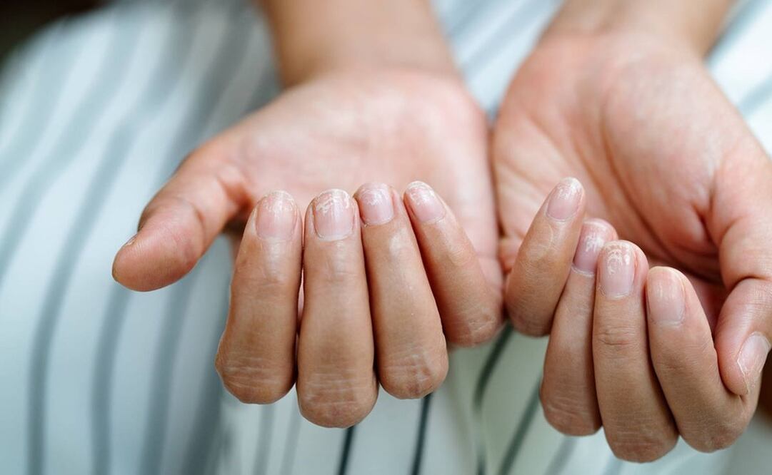 Descubre cómo puedes eliminar las estrías en las uñas. Foto: Pixabay