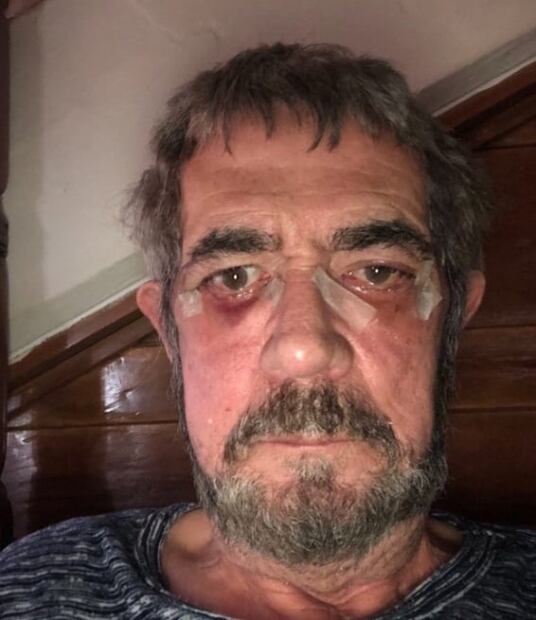 El "Flaco" Ibáñez aparece con moretones en el rostro: ¿Qué le pasó?