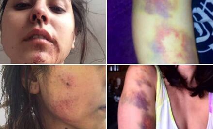 Young woman shares story of violent attack by ex-boyfriend and sparks public outrage