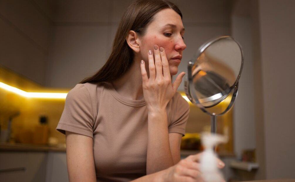 Las causas del acné pueden deberse a factores hormonales. Foto: Freepik
