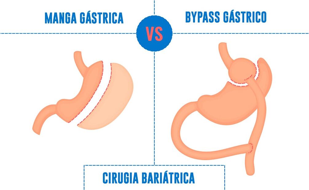 La manga gástrica y el bypass gástrico conforman las formas de cirugía bariátrica; cada una tiene ventajas como desventajas. Foto: Cortesía