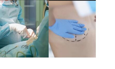 Mujer recibe disparo en el pecho y prótesis de silicona de sus senos le salvan la vida