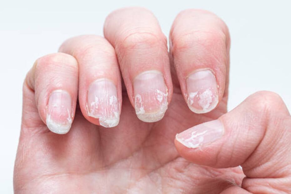 Las uñas quebradizas son un problema común. Foto: Pexels