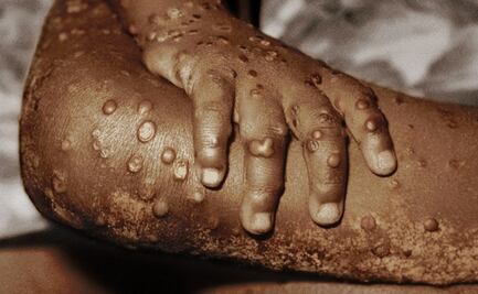 "Es el mayor brote jamás visto en Europa": la viruela de mono es detectada en más de 10 países